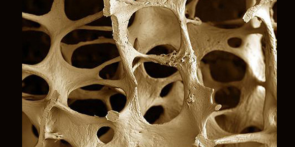 Osteoporoza Podstępna Choroba Której Trzeba Zapobiegać Kobietamagpl 0431