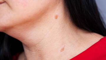 Włókniaki, punkty rubinowe, brodawki, kurzajki