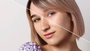 Zwalczamy blizny potrądzikowe