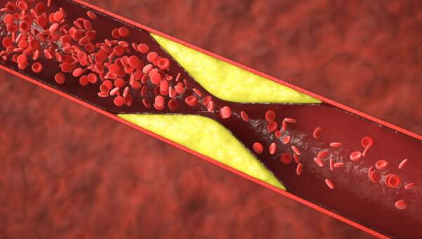 cholesterol