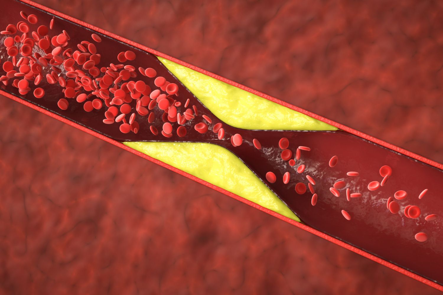 cholesterol