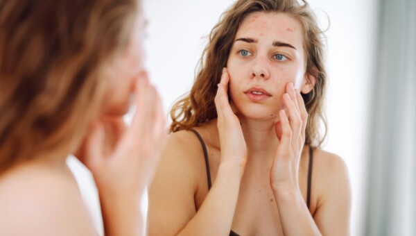 Młoda kobieta patrzy w lustro i bada zapalenie na twarzy, trądzik, skórę
