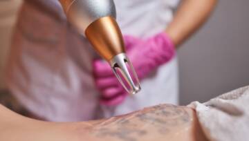 Młoda kobieta poddawana zabiegowi laserowego usuwania tatuażu w salonie