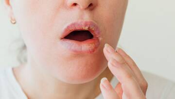 opryszczka na ustach
