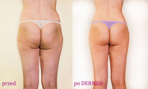 zabiegi wyszczuplające dermeo