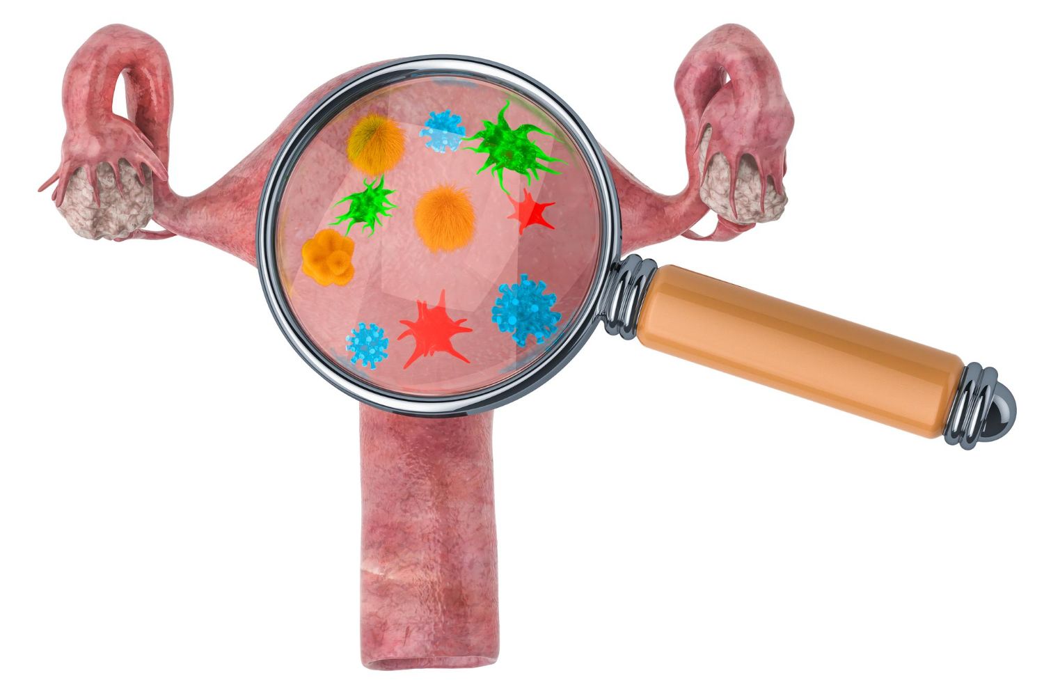 chlamydia