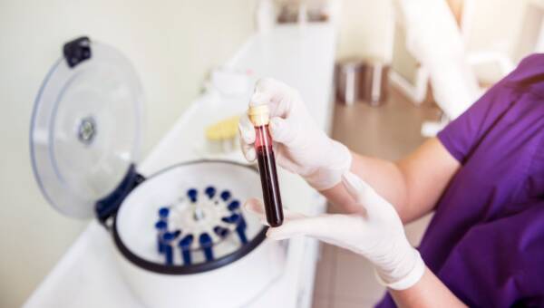 Osocze bogatopłytkowe