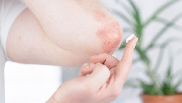 łuszczyca na łokciach