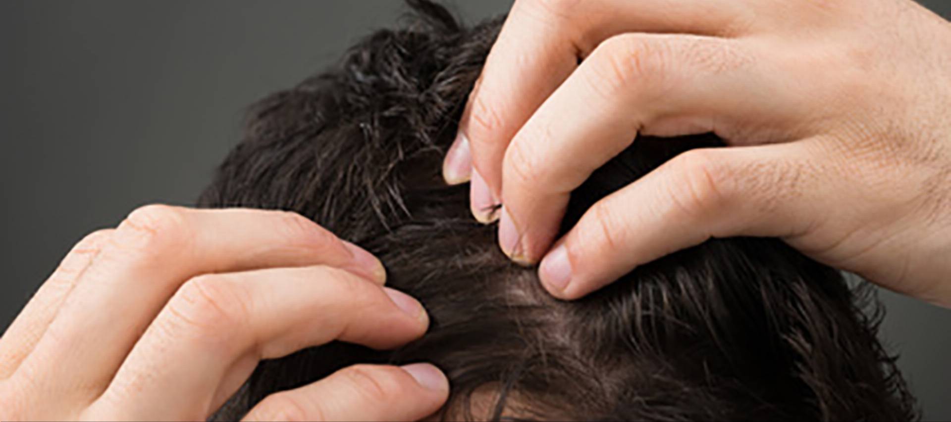 Cropped Image Of Man Suffering From Hair Loss