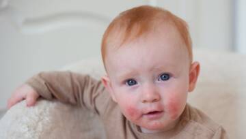 niemowlę z alergią