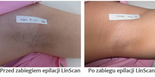 przed i po epilacji laserowej
