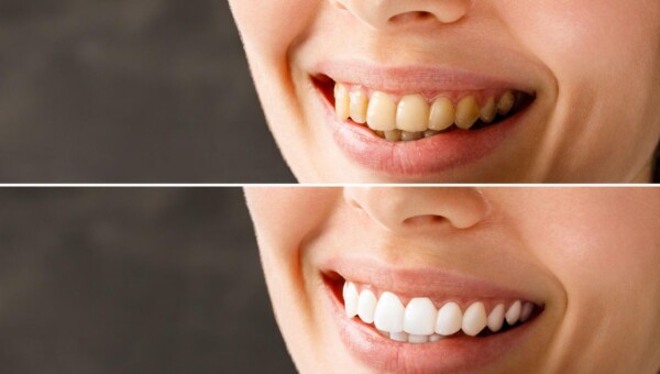 Zęby kobiety przed i po wybielaniu