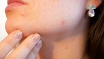 Leczenie trądziku – objawy, przyczyny, rodzaje choroby