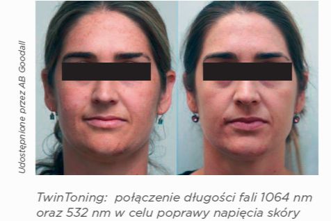 napięcie skóry przed i po zabiegu laserem