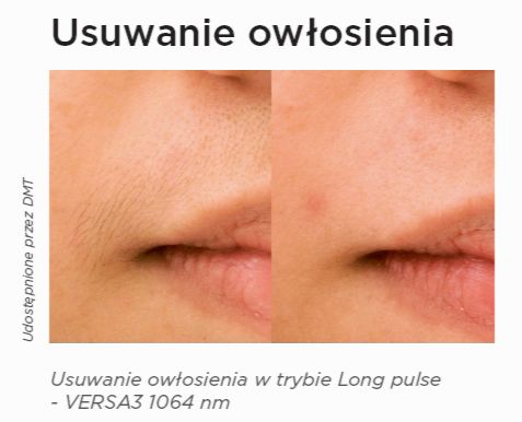 usuwanie owłosienia przed i po zabiegu laserem