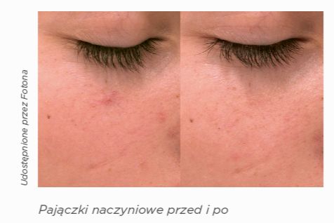 pajączki naczyniowe przed i po zabiegu laserem