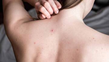 Trądzik na plecach i ramionach – jak pozbyć się krostek? Najlepsze sposoby