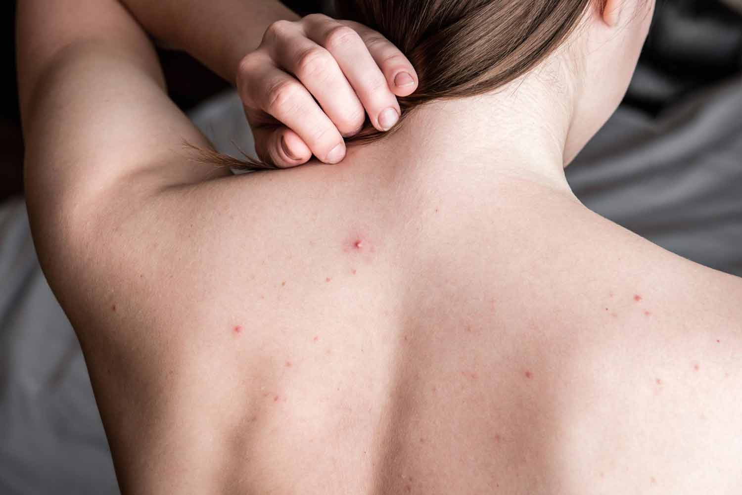 Trądzik na plecach i ramionach – jak pozbyć się krostek? Najlepsze sposoby fr Trądzik na plecach i ramionach – jak pozbyć się krostek? Najlepsze sposoby