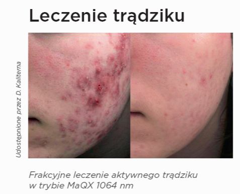 leczenie trądziku przed i po zabiegu laserem