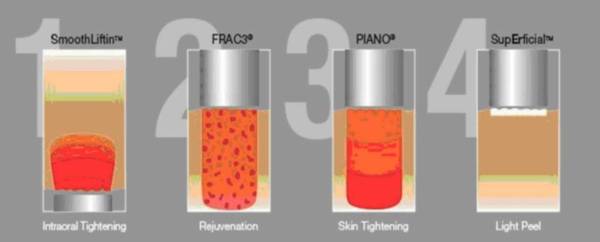 resurfacing peeling laserowy Fotona - jak działa