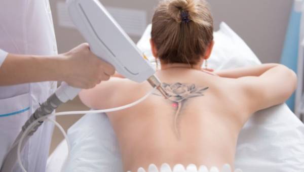 Laserowe usuwanie tatuażu – przebieg i efekty po zabiegu