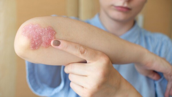 atopowe zapalenie skóry