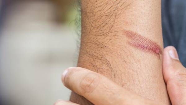 Oparzenia – jak przygotować się na taki uraz?