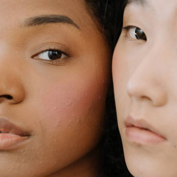 Jak pozbyć się zaskórników - domowe sposoby