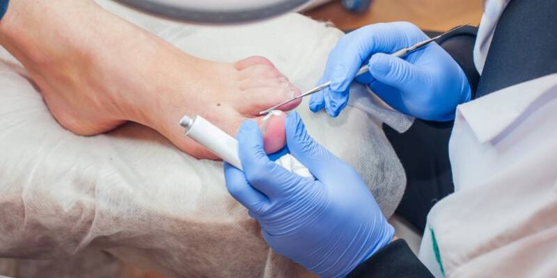 Skuteczne domowe sposoby na wrastający paznokieć