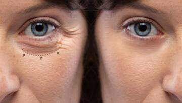 blefaroplastyka - powieki przed i po