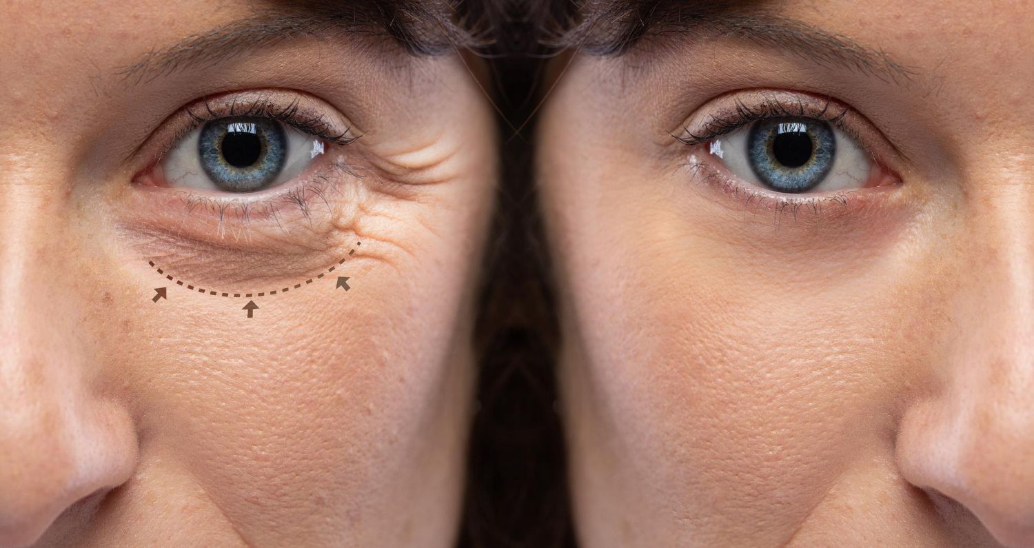 blefaroplastyka - powieki przed i po