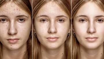 problemy skórne przed i po