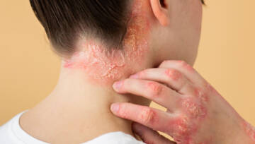 wyprysk-łuszczycy-na-szyi-pacjenta