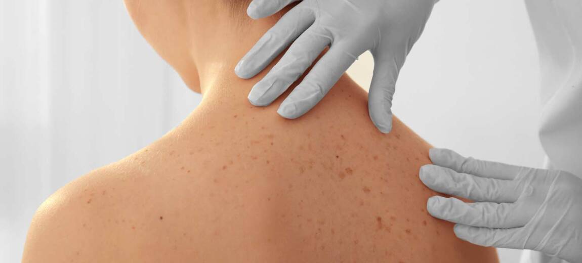 badanie skóry u dermatologa
