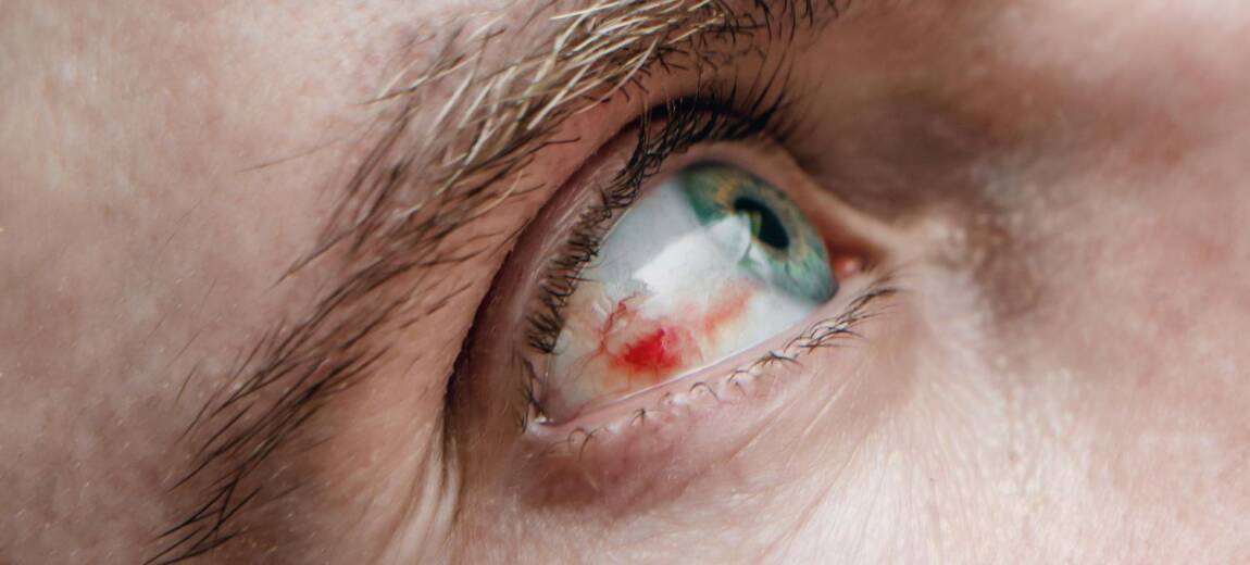 krew na białku oka